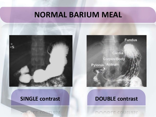 barium-meal-11-638