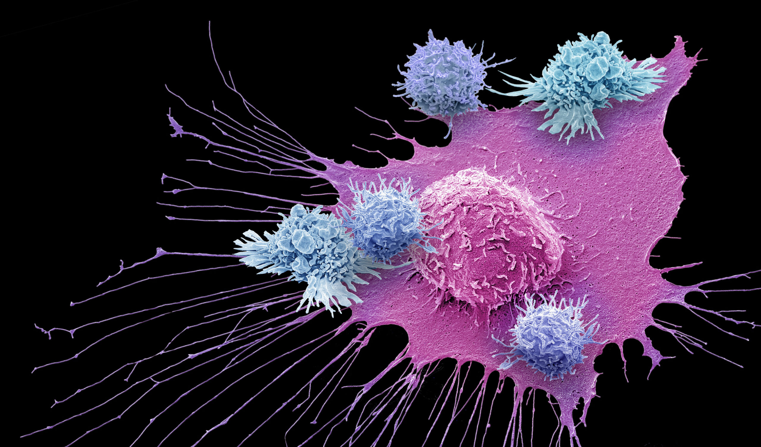 T cells (blue) of the immune system attack a cancer cell (pink) in this color-enhanced scanning electron micrograph. The 2018 Nobel Prize for Physiology or Medicine has been awarded for work leading to new therapies against cancer based on unleashing the latent power of the immune system to attack tumor cells.