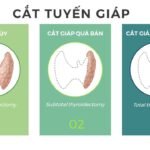 cat-tuyen-giap