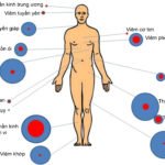 side-effects-of-pd-1-pd-l1-enlarge VN