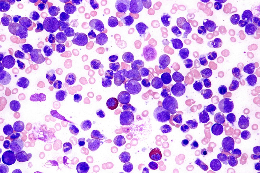 Acute myeloid leukemia is the most common type of acute leukemia in adults.