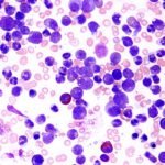 Leukemia-Blood-Smear