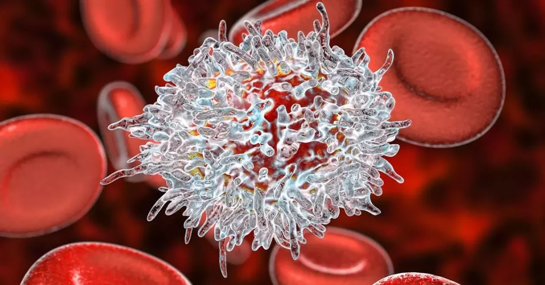 Bệnh máu trắng Leukemia
